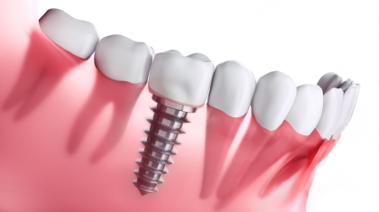 Nowe początki z implantami zębowymi: Jak odzyskać pewność siebie i funkcjonalność