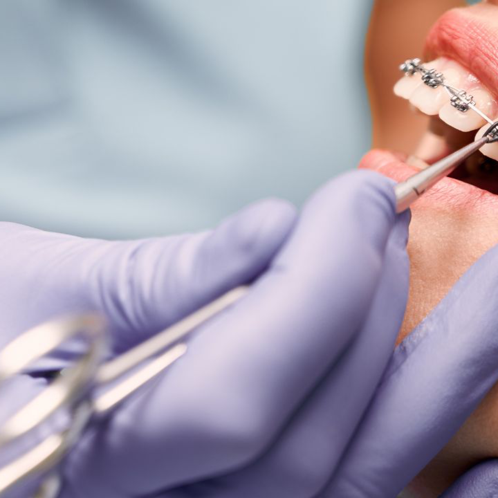 6 rzeczy, o których musisz wiedzieć przed rozpoczęciem leczenia ortodontycznego