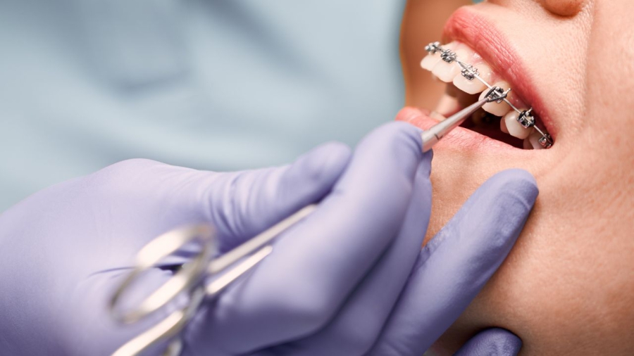 6 rzeczy, o których musisz wiedzieć przed rozpoczęciem leczenia ortodontycznego