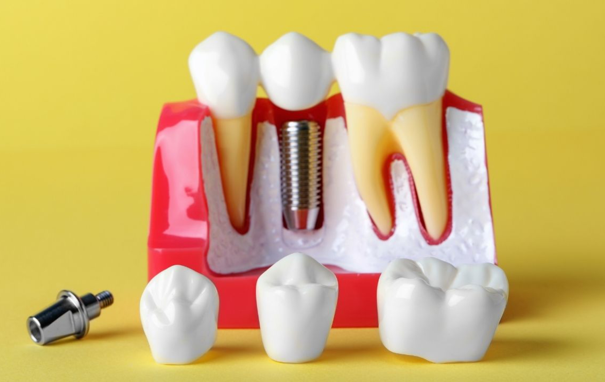 Doskonałość i trwałość: Korony protetyczne jako rozwiązanie dla utraty zębów