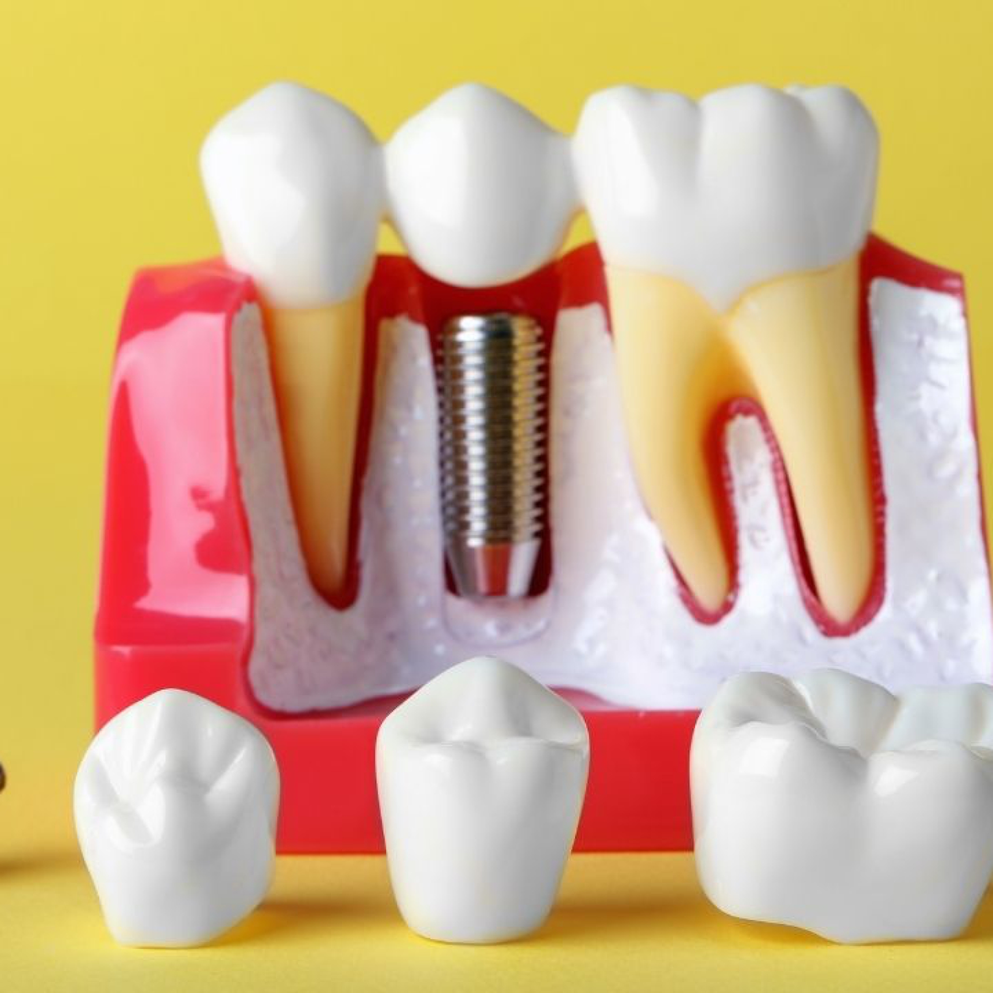 Doskonałość i trwałość: Korony protetyczne jako rozwiązanie dla utraty zębów